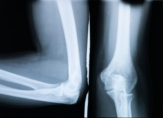 X-ray with the elbow wrists of a woman with osteoarthritis