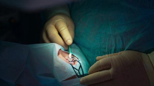 Eyesight clinic operating cataract surgery proccess. Surgery eye laser correction.