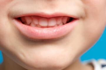 Children's milk teeth in a child, open mouth, close-up. Pediatric dentistry, thinned enamel