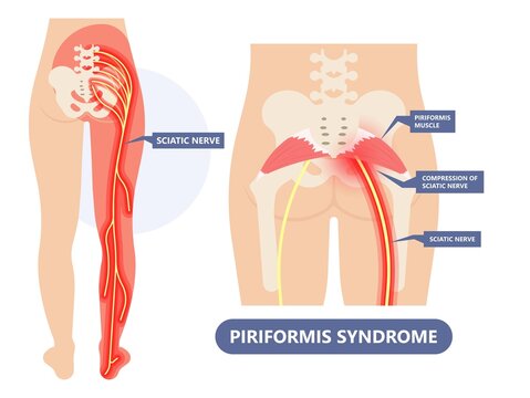 Piriformis syndrome pain and numbness in buttocks and down the back of leg