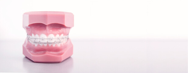 Kieferorthopädisches Modell  zur Demonstration der Brackets, Klammern oder Zahnspange, COPY SPACE,...