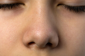 Closeup blackhead pimples on teenage boy's nose. Skin care problems because of hormones changes in...