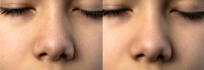 Close-up blackhead acne blames on boy's nose. Compare before and after treatments, skin care...