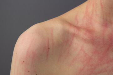 Fototapeta premium Closeup of a young woman’s skin with dermatographia, also known as skin writing.