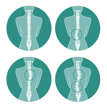 Scoliosis anatomy types