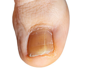 Detail of a foot toenail with fungus. Close-up of the big toe of the foot with fungus on nail...
