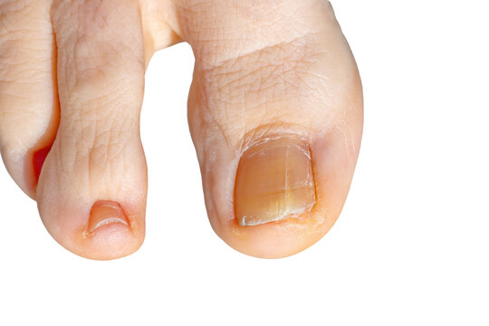 Detail of a foot toenail with fungus. Close-up of the big toe of the foot with fungus on nail isolated on white background