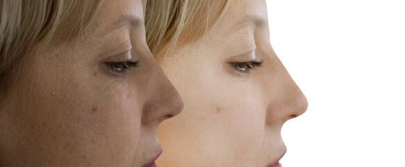woman face wrinkles before and after treatment