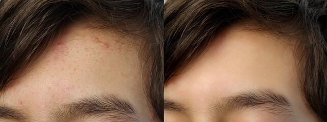 Image compare before and after acne treatment on teenage boy's forehead because of hormone changes. Problem face skin and beauty concept. - obrazy, fototapety, plakaty