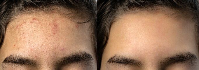 Image compare before and after acne treatment on teenage boy's forehead because of hormone changes....
