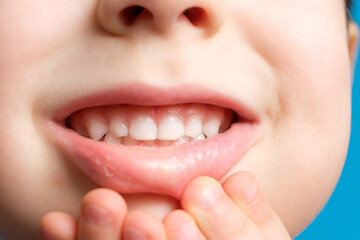 Children's milk teeth in a child, open mouth, close-up. Pediatric dentistry, thinned enamel
