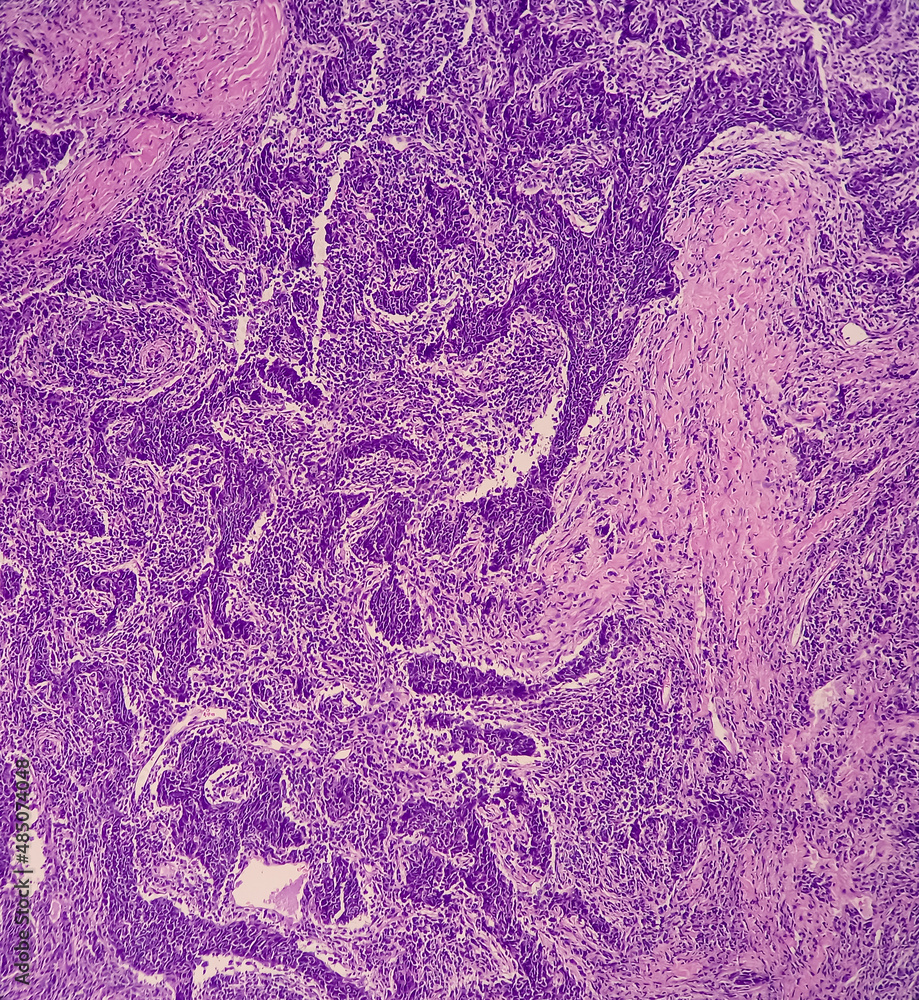 Wall mural Nasopharyngeal carcinoma, nasopharynx cancer, microscopic show malignant tumor of atypical epithelial cells with prominent nuclei, most common cancer originating in the nasopharynx.