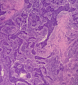 Nasopharyngeal Carcinoma, Nasopharynx Cancer, Microscopic Show Malignant Tumor Of Atypical Epithelial Cells With Prominent Nuclei, Most Common Cancer Originating In The Nasopharynx.