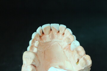 Poscelain veneers in tooth model before submitting to the dentist for further implantation to the patient is a beauty cosmetic