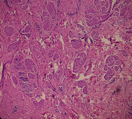 Nipple ulcer biopsy: Paget's disease of the nipple, microscopic image show skin, It reveals features of Paget's disease of nipple, focus 40x view.