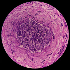 Nipple ulcer biopsy: Paget's disease of the nipple, microscopic image show skin, It reveals...