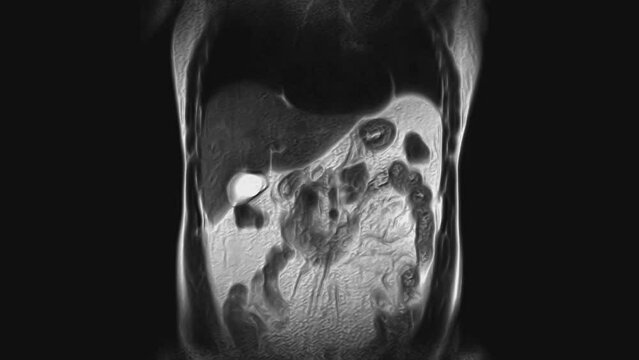 Voluminous CT scan of the abdomen. Computed tomography of the gastrointestinal tract, liver and kidneys