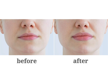 Augmentation of the lips of Caucasian woman.. Cosmetological injections. Before and after.