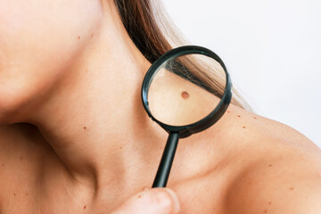 Close-up of a big mole on a young woman's neck magnified with a magnifying glass isolated on a gray...