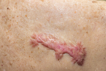 Patient with Spontaneous keloid scar