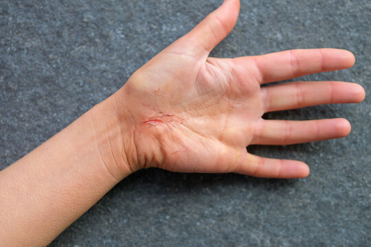 Close up of a injured hand