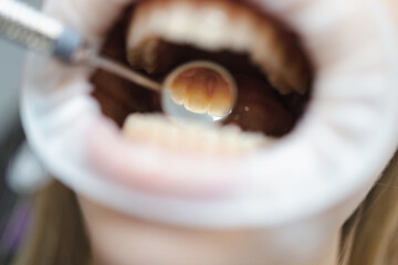 Close-up dental mirror in the mouth. .Macro photography of the process of examining teeth