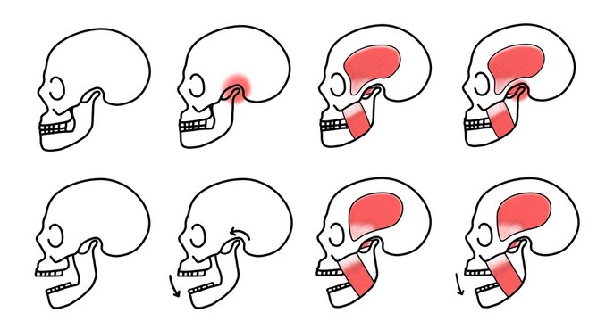 Illustration of lateral view of human skull, normal skull, mouth opening, red highlight on TMJ, muscle of mastication, Dental icon for Occlusion.