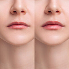 Female lips before anf after augmentation procedure.