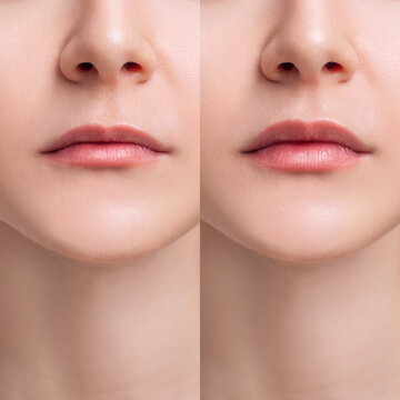 Female lips before anf after augmentation procedure.