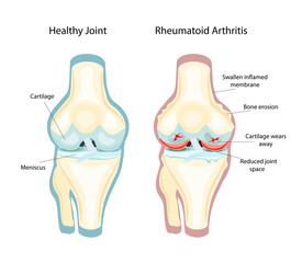 Rheumatoid Arthritis RA that usually affects knees. the auto immune disease. Vector Illustration