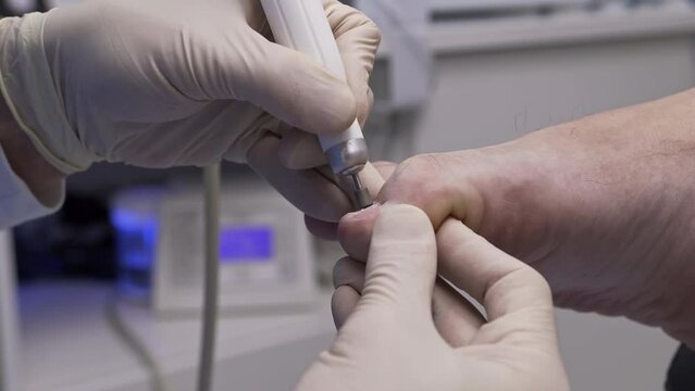 Clinic podology orthopedics treatment legs, feet, nails. Doctor blue gloves cuts lateral ridge big toe cutter, smoothing polishing deformed, damaged, ingrown nail. Prophylactic appointment specialist
