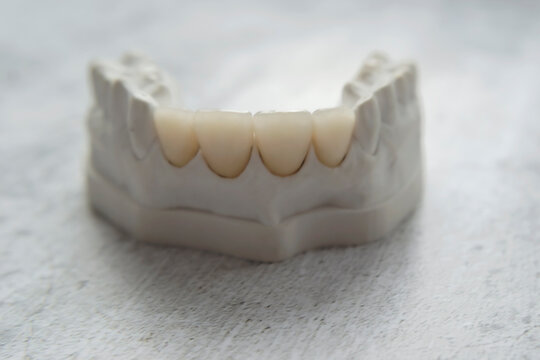 Сollapsible dental model for dental prostheses, metal ceramics, metal-free ceramics, model from refractory gypsum according to Geller. Veneers manufacturing clinic, aesthetic dentistry