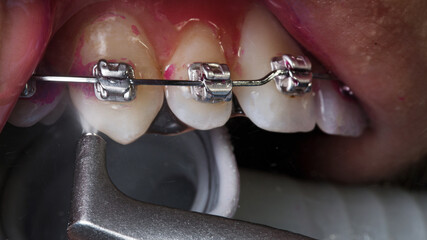 professional dental hygiene through braces of the upper jaw with special equipment © Dental Pro Content