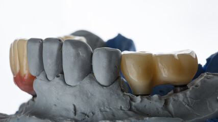 mini dental bridge prosthesis made of zircon for two teeth with a white background