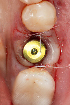 macro photo on the gum shaper after dental implantation of the chewing tooth