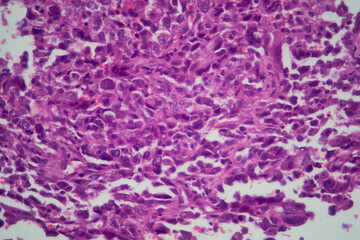 Lung tissue adenocarcinoma with HE stain as seen under a microscope.