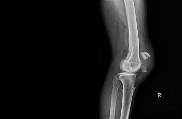 A film x-ray of left knee lateral view shown fracture of knee cap(patella) bone. The plain film on...
