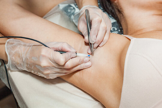 The process of permanent removal of unwanted hair in the armpit area using an electroepilation device and tweezers