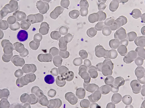 Blood smear microscopic show Reactive lymphocytes and Neutropenia.