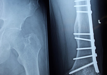 Plain X ray on the left femur that shows united mid shaft left femur fracture after open reduction...