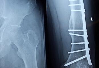 Plain X ray on the left femur that shows united mid shaft left femur fracture after open reduction...