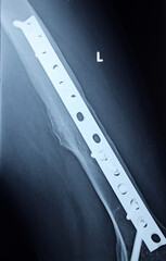 Plain X ray on the left femur that shows united mid shaft left femur fracture after open reduction...