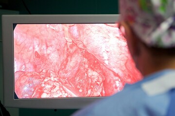 Surgeon looking at monitor performing laparoscopic surgery