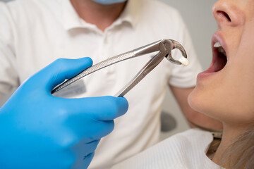 Close-up of the process of removing a tooth from the oral cavity. The doctor holds the forceps with the extracted tooth near the client's jaw.