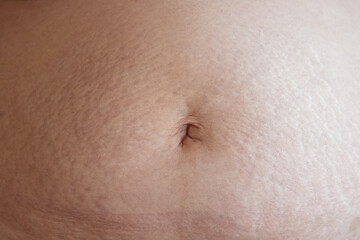 Fototapeta premium ESTOMAGO DE MUJER DESPUES DE EMBARAZO CON ESTRIAS