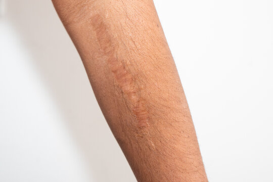 CICATRIZ HOMBRE ANTEBRAZO
