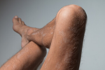 Naklejka premium Large plaque parapsoriasis on caucasian man legs