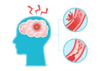 Human head with brain stroke disease, atherosclerosis, hemorrhage and pain point. Vector flat infographic medical concept illustration. Design for poster, print, background, landing page