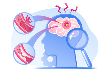 Human head with brain stroke disease, atherosclerosis, hemorrhage and pain point. Vector flat infographic medical concept illustration. Design for poster, print, background, landing page
