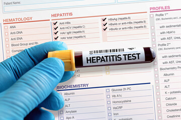 Blood tube test with requisition report for Hepatitis test. Blood sample tube for analysis of...